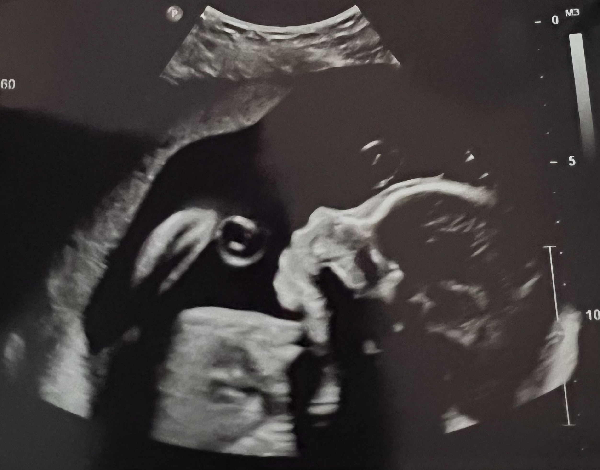 Baby Ultrasound